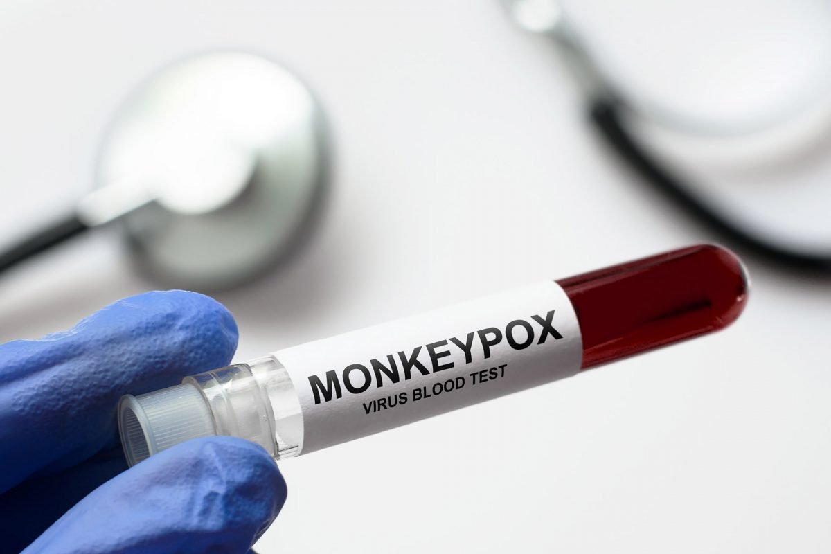 Monkeypox lab testing in Charlotte NC