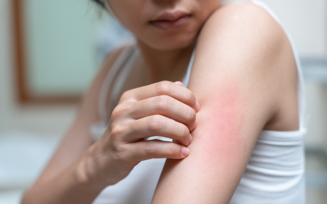 What is Heat Rash?