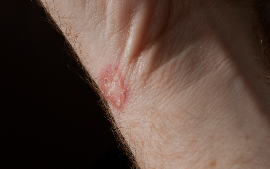 Ringworm: Recognizing the Symptoms
