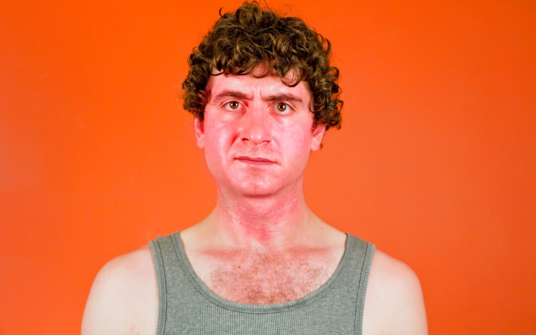 What a Sunburn Really Does to Your Skin