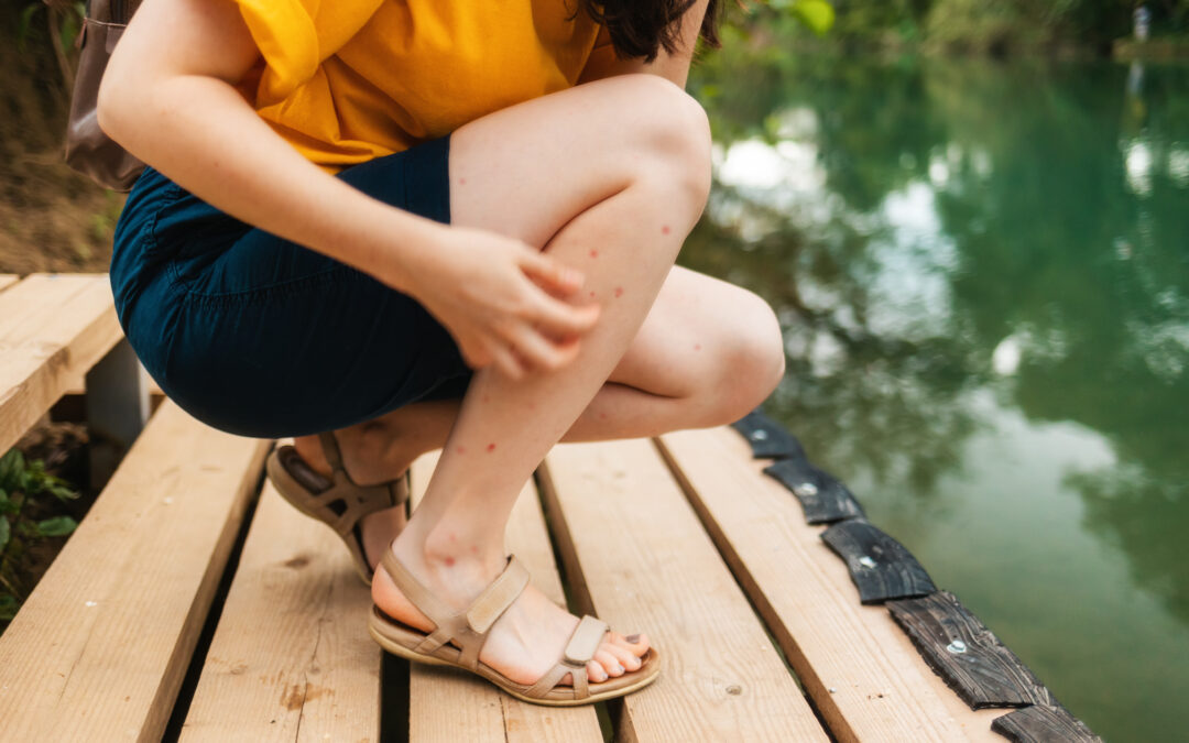 Large Mosquito Bite? Signs of an Allergy | AFC South Asheville
